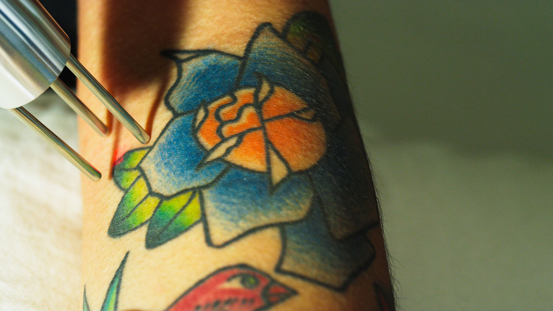 Deleted Scene Tattoo Removal