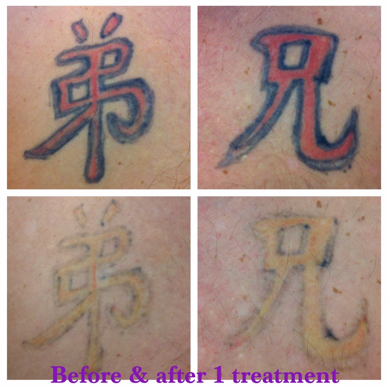 Magic Laser Tattoo Removal