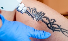 Bye Bye Ink Laser Tattoo Removal