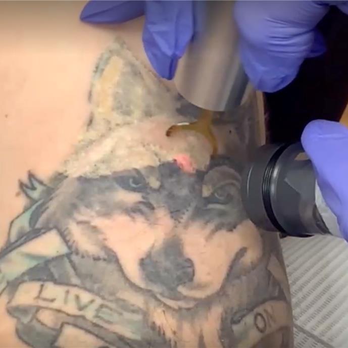 Clean Slate Laser Tattoo Removal - Brooklyn