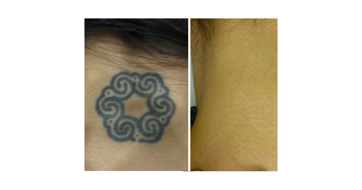 INK B GONE Tattoo Removal Denver