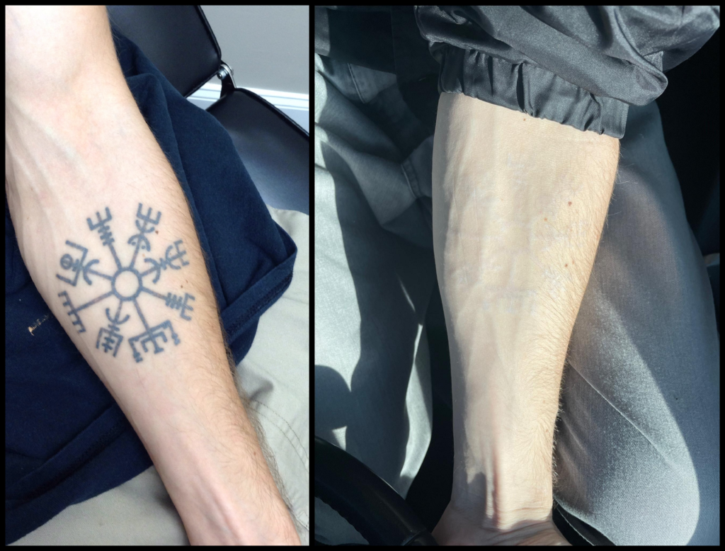 Inkaway Laser Tattoo Removal