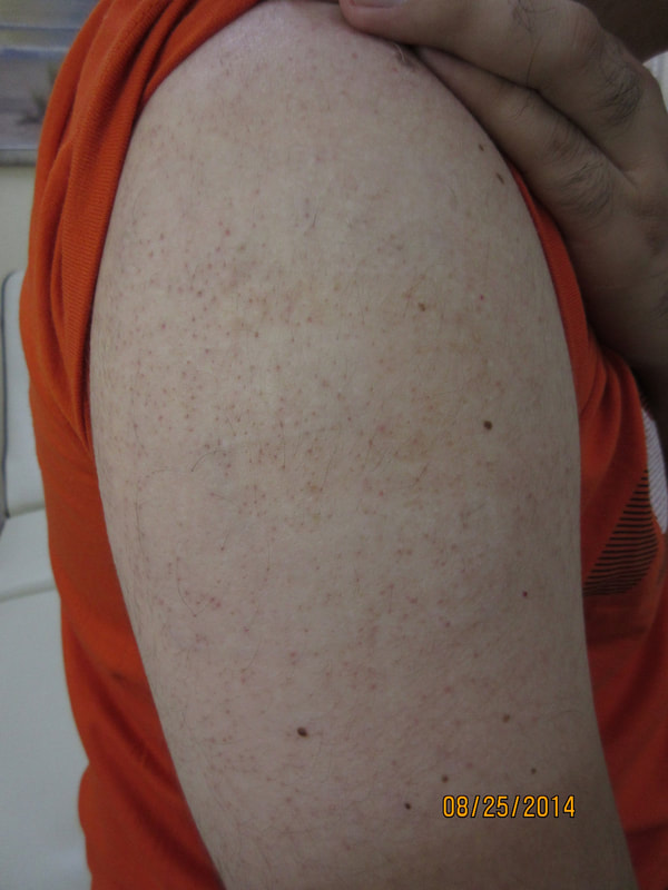 Serenity Tattoo Removal