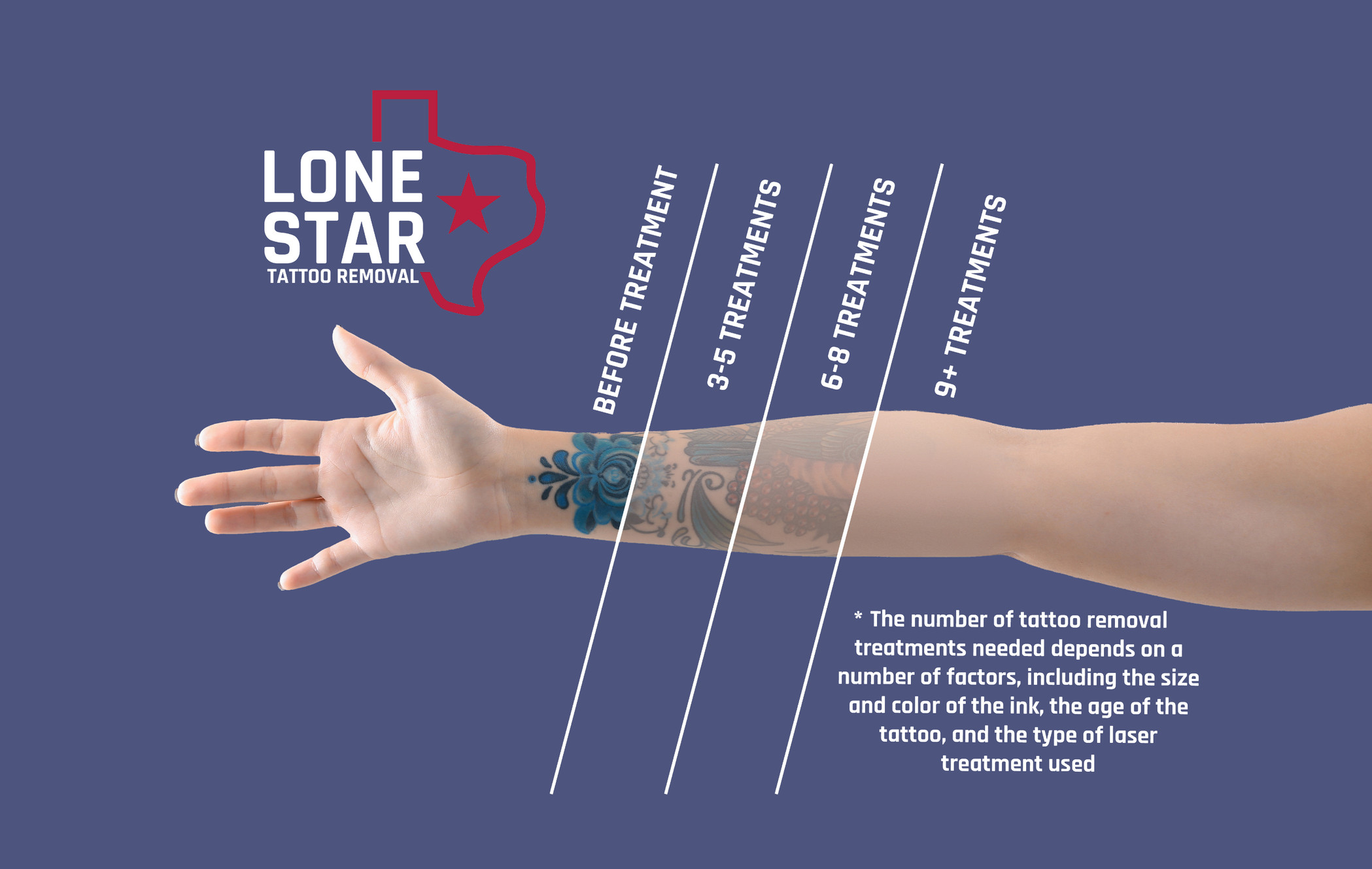 Lone Star Tattoo Removal