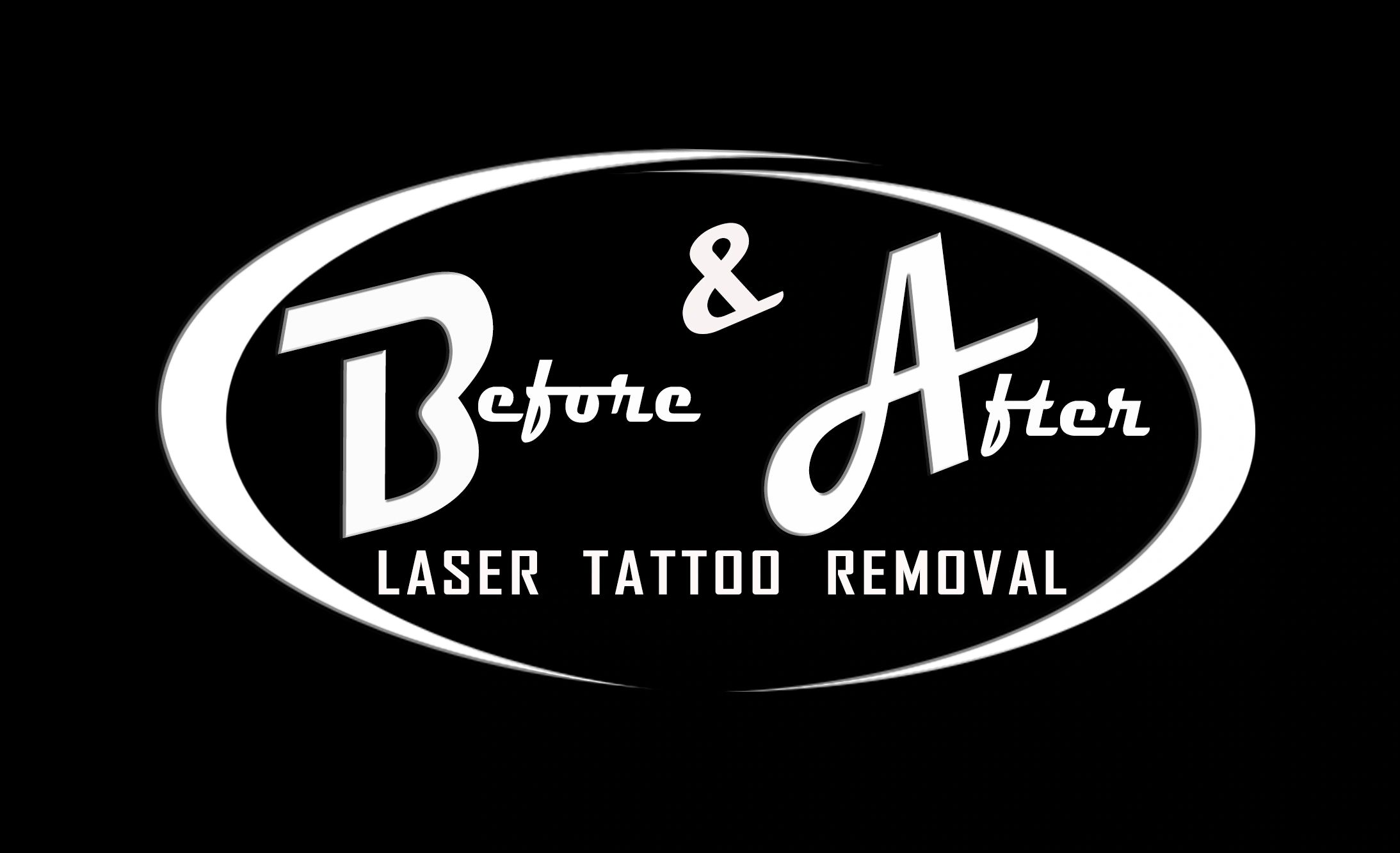 Before & After Laser Tattoo Removal